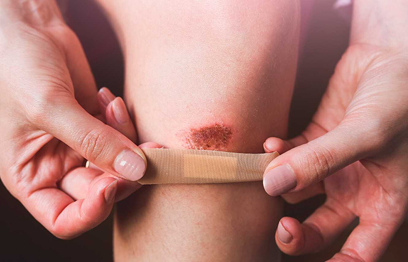 На Львівщині випадок правця у дорослого: медики закликають не нехтувати вакцинацією