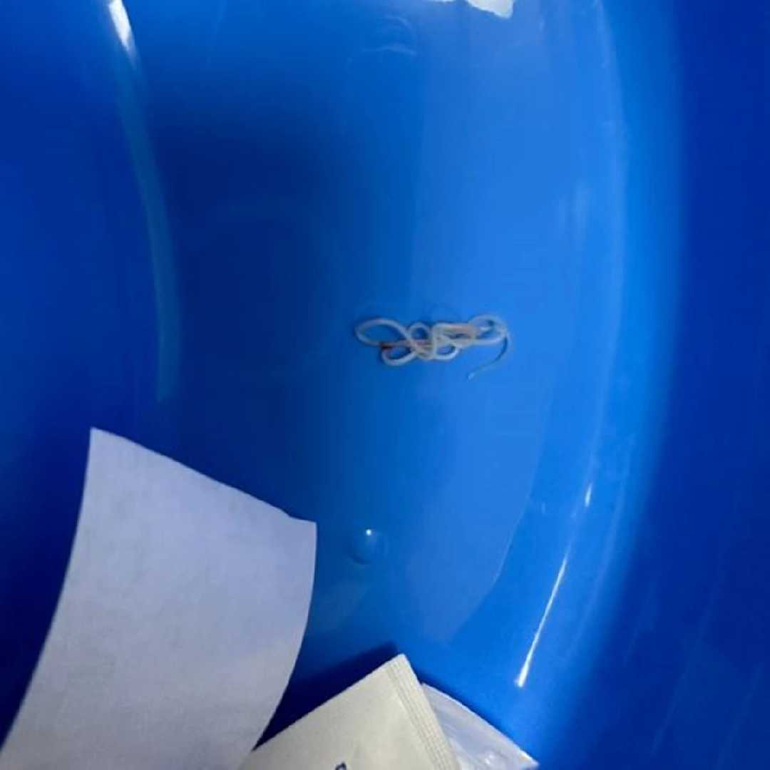 Хірурги «ОХМАТДИТу» видалили з-під шкіри 5-річного хлопчика підступного паразита - дирофілярію